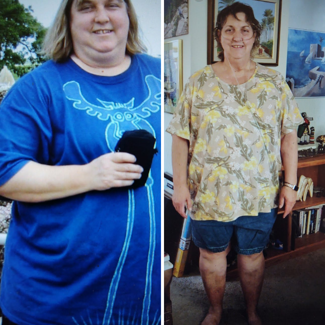 Before and After Bariatric Surgery  posing before and after surgery